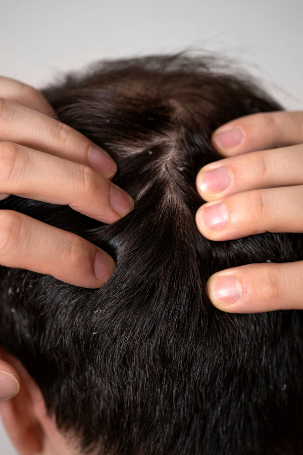 DRY / IRRITATED SCALP