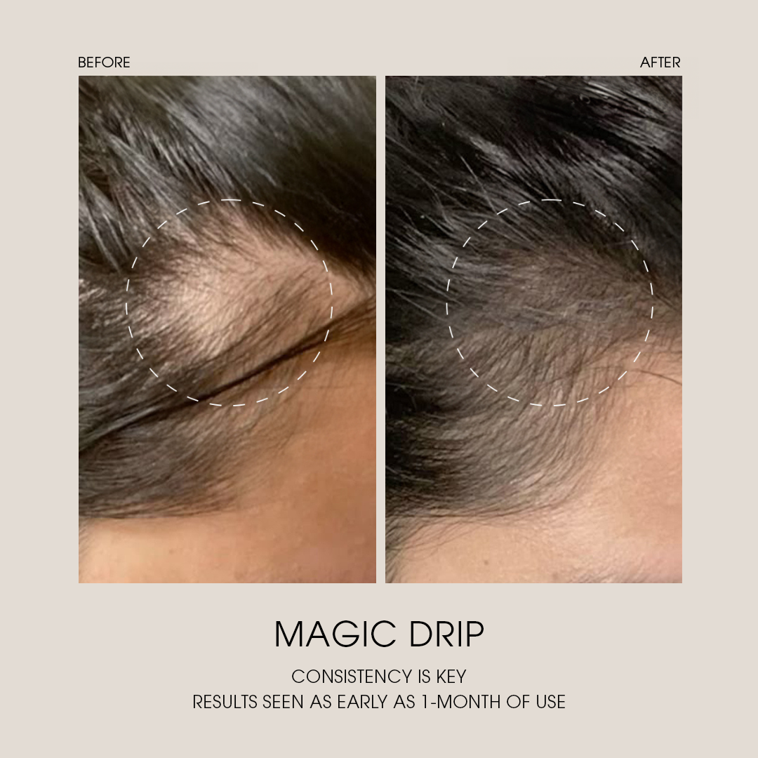 Before and after visible hair density improvement using Magic Drip