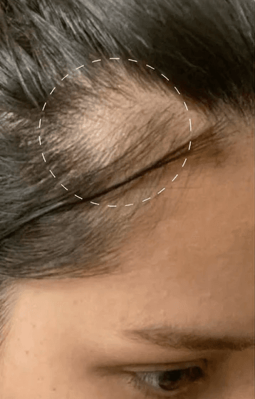 Magic Drip · Thinning + Fine Hair before